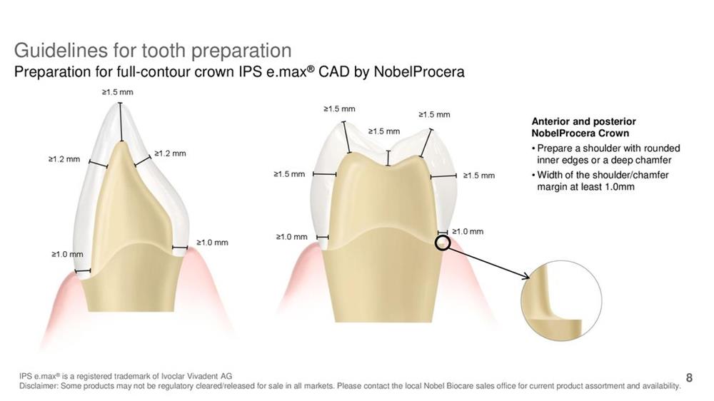 Tooth preparation design diagram