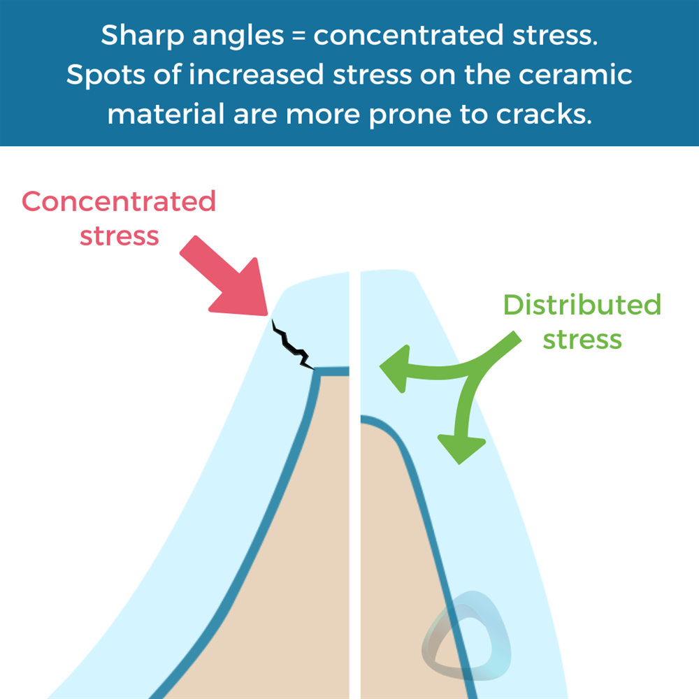 Tooth preparation design diagram